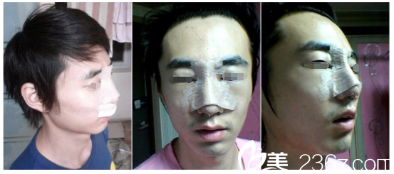 剛做完硅膠隆鼻手術(shù) 剛做完硅膠隆鼻手術(shù)