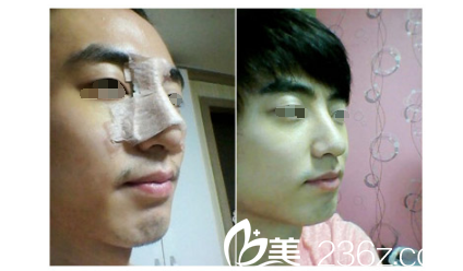 硅膠假體隆鼻術(shù)后恢復(fù) 硅膠假體隆鼻術(shù)后恢復(fù)