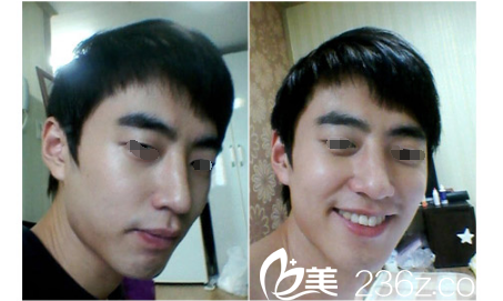 術(shù)后兩周硅膠假體隆鼻恢復(fù) 術(shù)后兩周硅膠假體隆鼻恢復(fù)