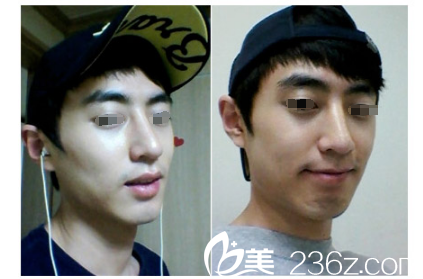 假體隆鼻術(shù)后一個月恢復(fù) 假體隆鼻術(shù)后一個月恢復(fù)