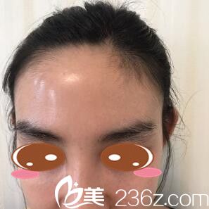 發(fā)際線種植術(shù)前照 發(fā)際線種植術(shù)前照