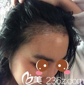 種植發(fā)際線半個月 種植發(fā)際線半個月