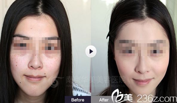 南京華美整形美容醫(yī)院激光祛斑對比圖
