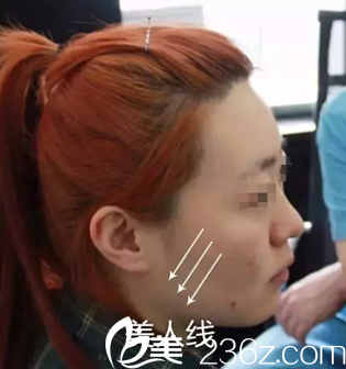 我在<!--<i data=20240703-sp></i>-->做6D面部線雕提升手術(shù)中照片 我在<!--<i data=20240703-sp></i>-->做6D面部線雕提升手術(shù)中照片