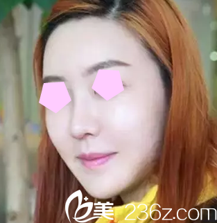 來看看我在整形做6D面部線雕提升一周后的照片，對比效果明顯嗎？