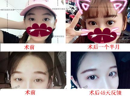 屬于亳州締美整形六針美瞳綜合美眼術(shù)案例反饋