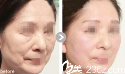 締美整形微拉美案例效果對比照片