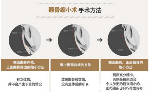 3D顴骨縮小手術(shù)方法 3D顴骨縮小手術(shù)方法