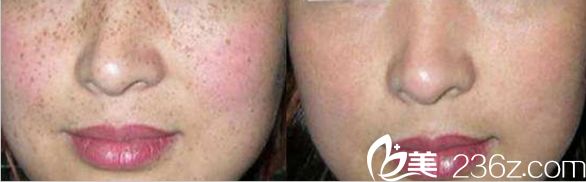 沈陽(yáng)美萊整形醫(yī)院激光祛斑對(duì)比圖