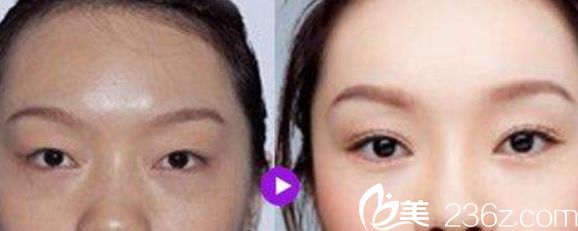 沈陽(yáng)美萊美容醫(yī)院雙眼皮<span style=
