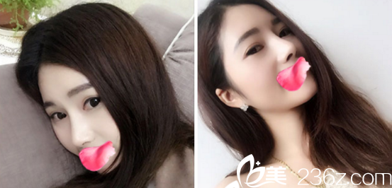 在煙臺鵬愛整形醫(yī)院同時做了全切雙眼皮+鼻綜合，也就是上上個月，到現(xiàn)在有兩個月了，做的是肋軟骨是會比較貴一點