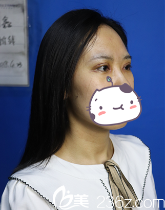 重瞼術(shù)內(nèi)眼角手術(shù) 重瞼術(shù)內(nèi)眼角手術(shù)