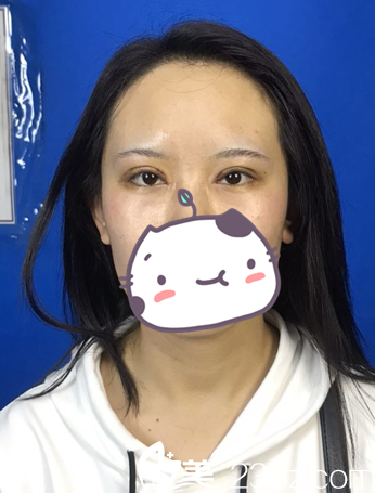 呼和浩特京美開眼角十天 呼和浩特京美開眼角十天