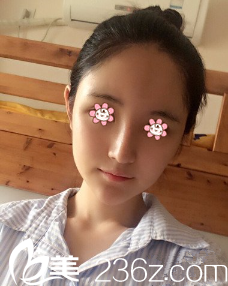 何山自體脂肪填充額頭術(shù)后十天 何山自體脂肪填充額頭術(shù)后十天