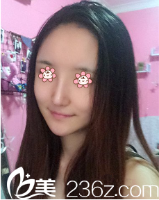 何山鼻綜合術(shù)后27天 何山鼻綜合術(shù)后27天