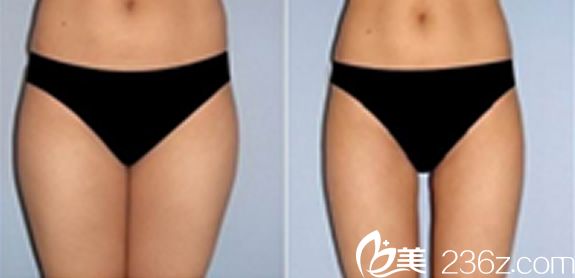 韓國本沐整形全身抽脂效果圖 韓國本沐整形全身抽脂效果圖