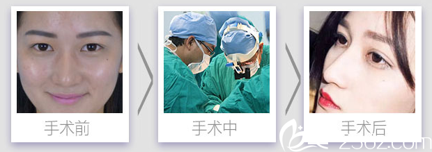 <!--<i data=20240703-sp></i>-->醫(yī)生全切雙眼皮手術(shù)案例