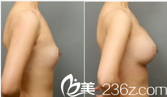 韓國Pureart整形外科醫(yī)院脂肪豐胸案例 韓國Pureart整形外科醫(yī)院脂肪豐胸案例