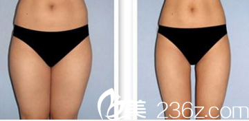 韓國Pureart整形外科醫(yī)院腿部吸脂案例 韓國Pureart整形外科醫(yī)院腿部吸脂案例