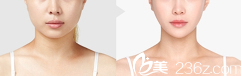 韓國Pureart整形外科醫(yī)院面部輪廓案例 韓國Pureart整形外科醫(yī)院面部輪廓案例