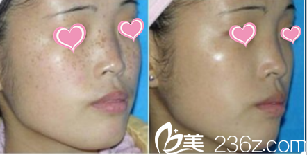 韓國Pureart整形外科醫(yī)院皮膚美容案例 韓國Pureart整形外科醫(yī)院皮膚美容案例