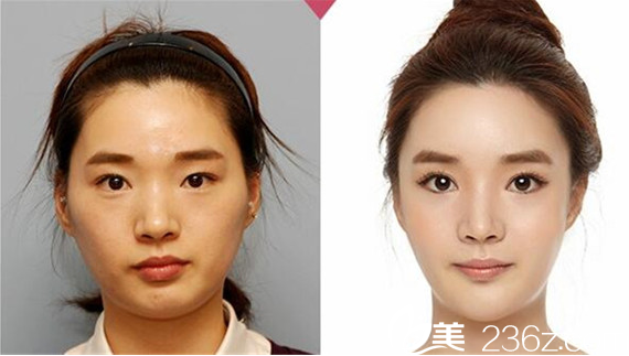 袁耀東眼部整形案例 袁耀東眼部整形案例