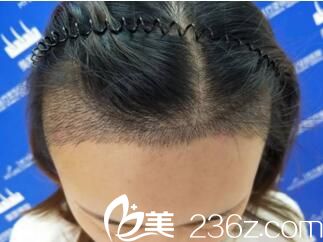 發(fā)際線種植一周 發(fā)際線種植一周