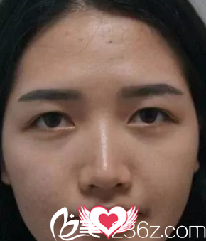 術前內雙眼皮 術前內雙眼皮