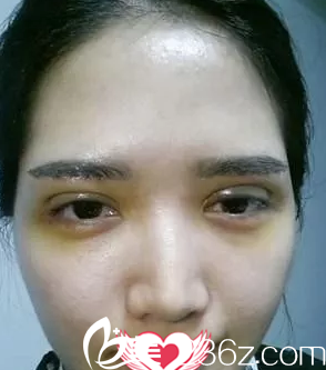 剛做完手術眼睛腫脹 剛做完手術眼睛腫脹