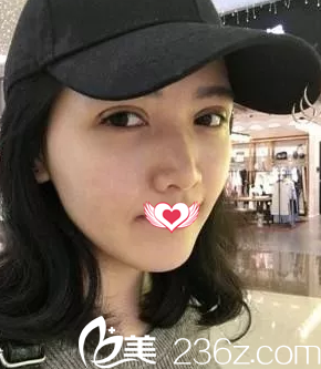 術后7天眼睛拆線后的樣子 術后7天眼睛拆線后的樣子