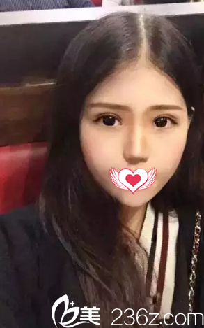 之前在石家莊貴美人注射玻尿酸和瘦臉后臉型超美 間隔半年又來(lái)找劉兵醫(yī)生割了雙眼皮效果依然很棒