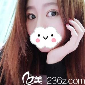 割雙眼皮術(shù)后半個(gè)月 割雙眼皮術(shù)后半個(gè)月