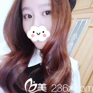 在郴州曹家整形做了全切雙眼皮一個(gè)月后終于讓我擺脫了單眼皮的困擾