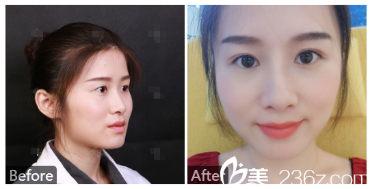 深圳美萊整形醫(yī)院林登文切開(kāi)雙眼皮案例圖