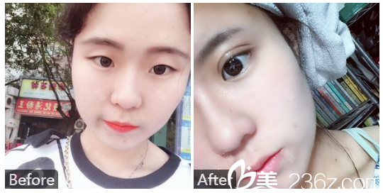 深圳美萊整形醫(yī)院梁志為雙眼皮案例對(duì)比圖
