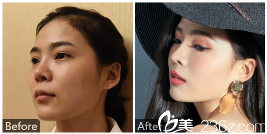 深圳美萊梁曉健鼻綜合隆鼻案例圖片