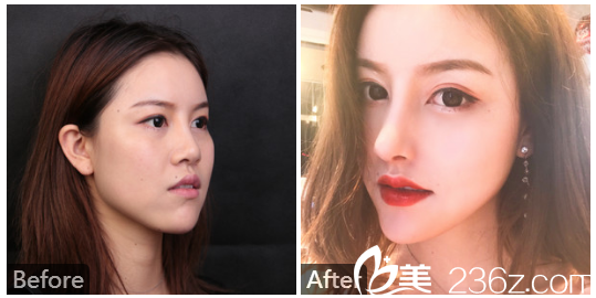 深圳美萊龍鵬輝膨體隆鼻案例圖片