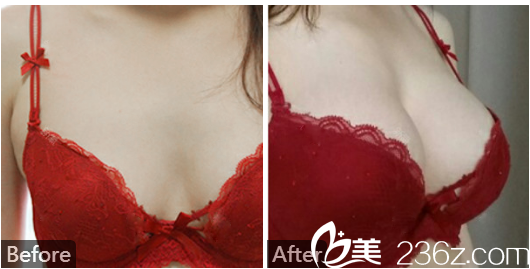 深圳美萊整形醫(yī)院郭杰假體隆胸案例圖