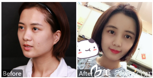 深圳美萊徐英全面部自體脂肪填充全臉案例