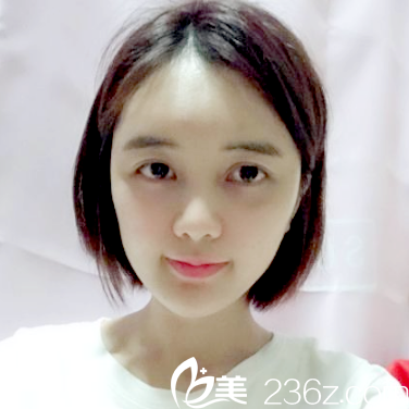 深圳美萊梁曉健做的自體脂肪面部填充案例術(shù)后一個(gè)月圖片 深圳美萊梁曉健做的自體脂肪面部填充案例術(shù)后一個(gè)月圖片