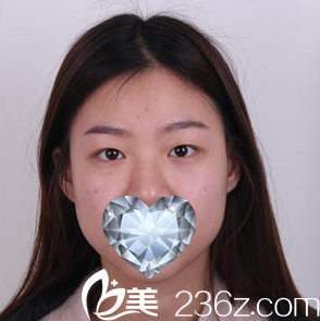 雙眼皮術(shù)前照 雙眼皮術(shù)前照