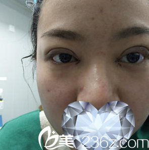 手術(shù)當天效果 手術(shù)當天效果