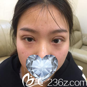 術(shù)后一周拆線 術(shù)后一周拆線