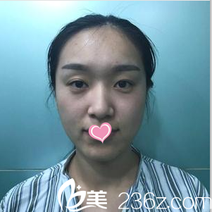 在北京櫻桃做眼修復(fù)前照片 在北京櫻桃做眼修復(fù)前照片