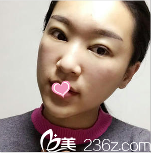 北京櫻桃雙眼皮修復(fù) 北京櫻桃雙眼皮修復(fù)