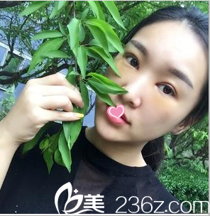 雙眼皮修復(fù) 雙眼皮修復(fù)