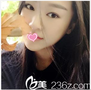 我只是在北京櫻桃做了切開雙眼皮修復(fù)+開眼角朋友說效果像原裝一般