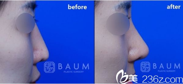 韓國柏恩整形鼻整形效果對比圖 韓國柏恩整形鼻整形效果對比圖