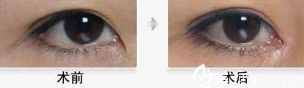 韓國優(yōu)容整形外科開眼角案例 韓國優(yōu)容整形外科開眼角案例