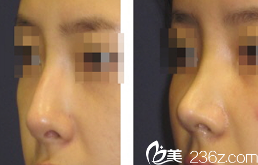 韓國伯恩整形美容醫(yī)院鼻綜合效果圖 韓國伯恩整形美容醫(yī)院鼻綜合效果圖